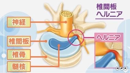 椎間板ヘルニア