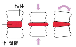 椎間板ヘルニア